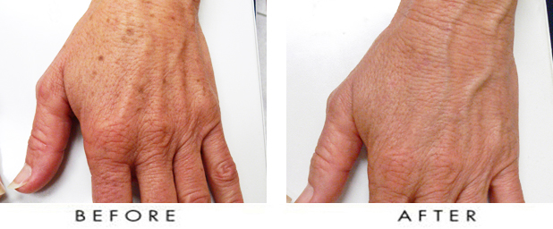 Hands-Age-Spots-Treatment