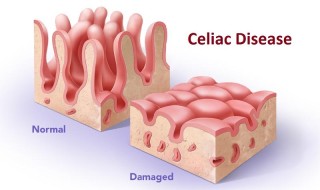 Everything You Need to Know About Celiac Disease 