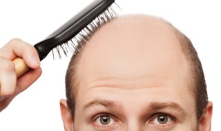 How to Effectively Treat Baldness?