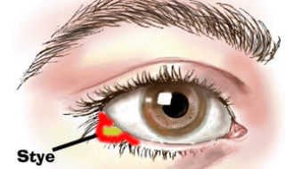 Heal Eye Sties With Home Remedies