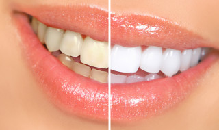 Whiten Your Teeth with Natural Remedies