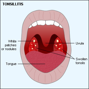 Cinnamon and Lemon for Tonsillitis | Top Natural Remedies