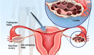 Herbal Treatments for Polycystic Ovary Syndrome