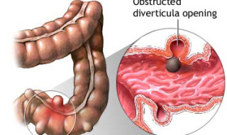 Slippery Elm and Marshmallow – The Best Remedies for Diverticular Disease
