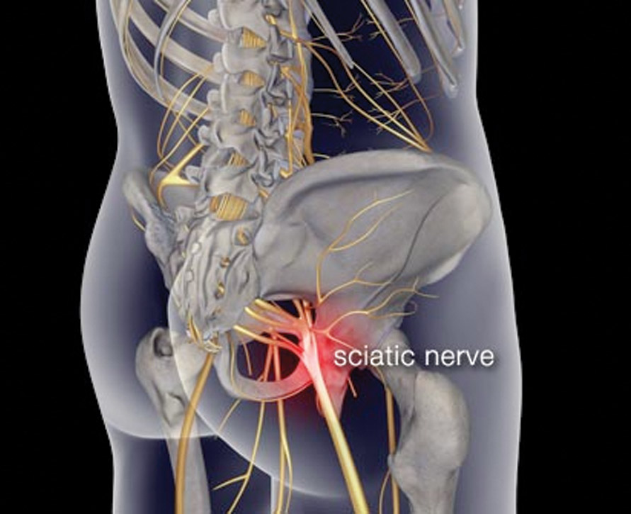 sciatic pain remedies