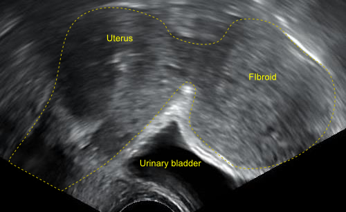 Uterine Fibroids symptoms