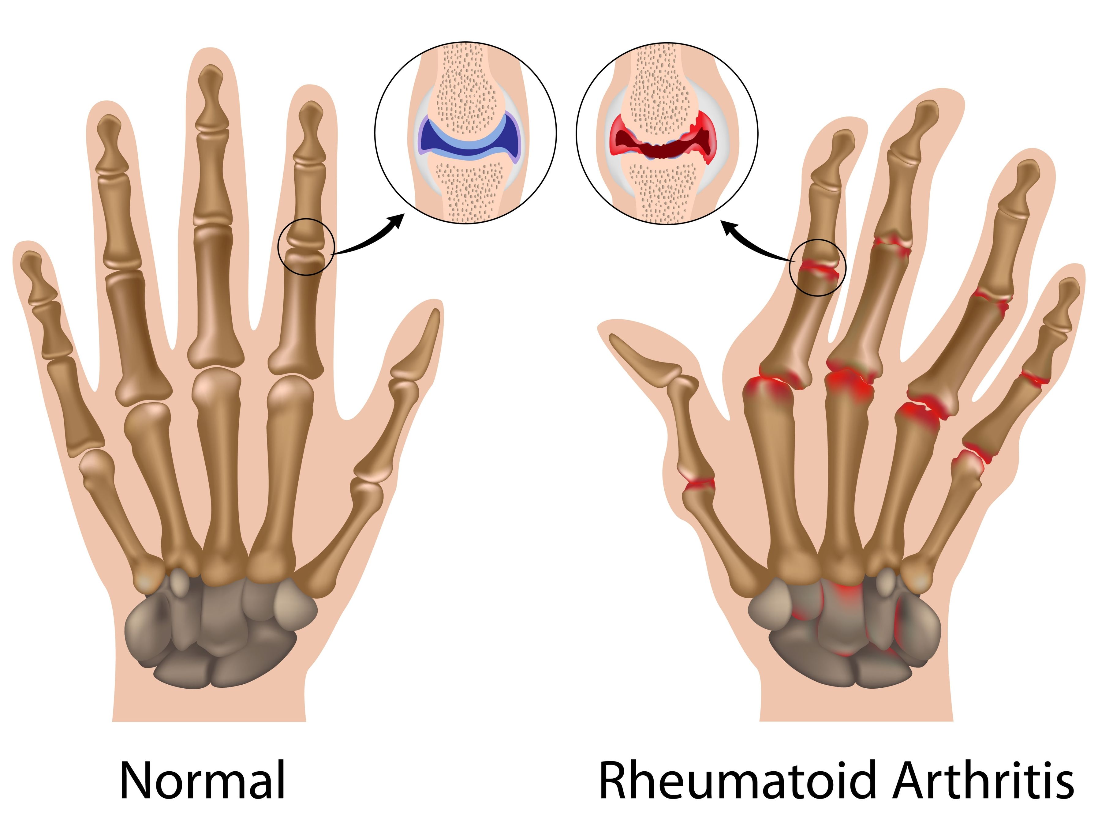 Do you have arthritis? Here is what you should not eat!