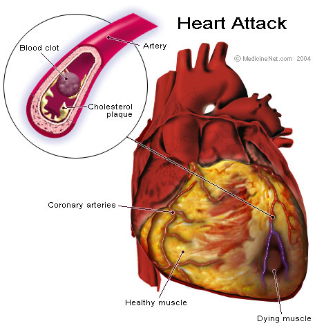 lifestyle changes to prevent heart attack