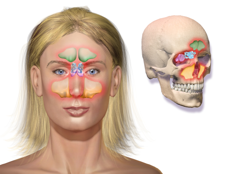 Sinus Infection How To Treat It Without Antibiotics Top Natural