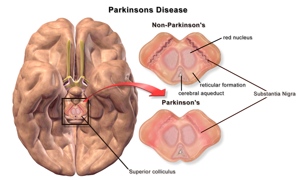 parkinson's disease details