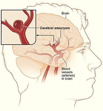 aneurysms info