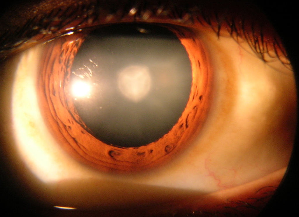 cataract remedies