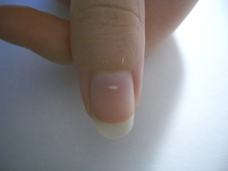 white spots on the nails