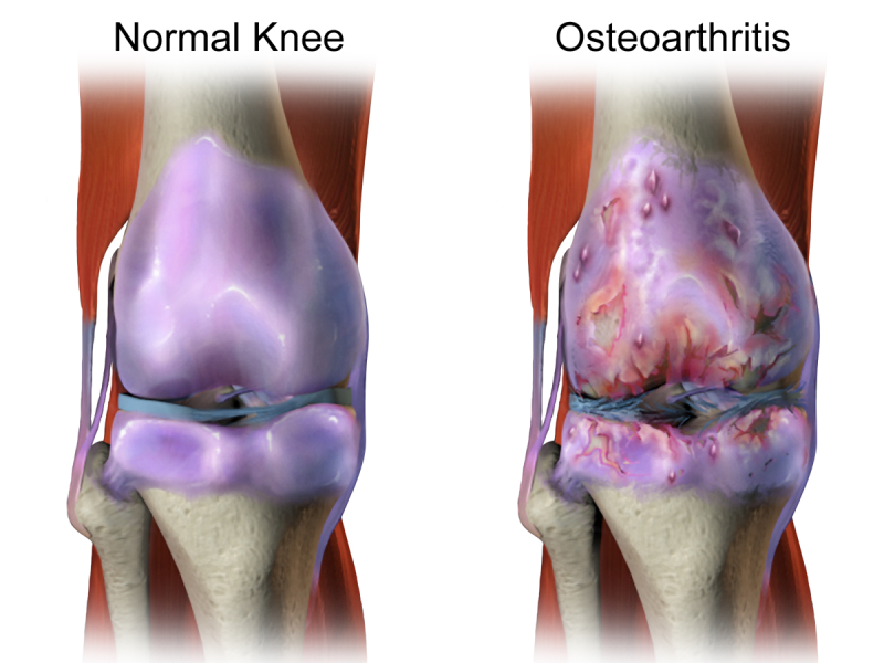 Osteoarthritis in Youngsters