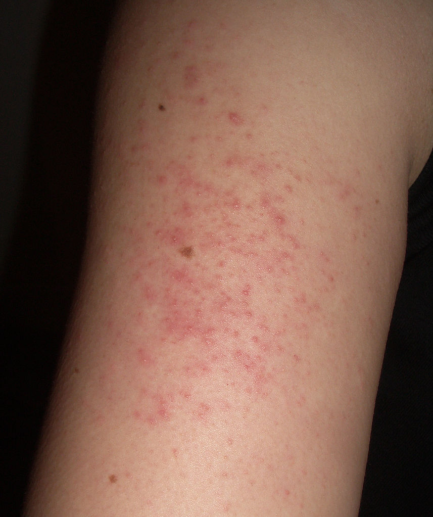 keratosis-pilaris-treatment